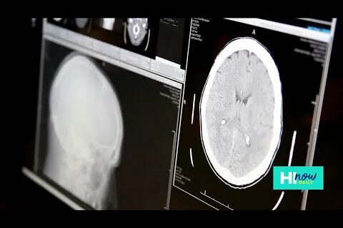 Advances in Alzheimer’s Improve Brain Health in Patients