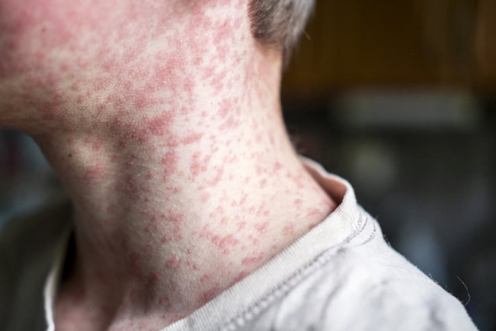 As Measles Exploded, Officials in Texas Looked to CDC Scientists. Under Trump, No One Answered.