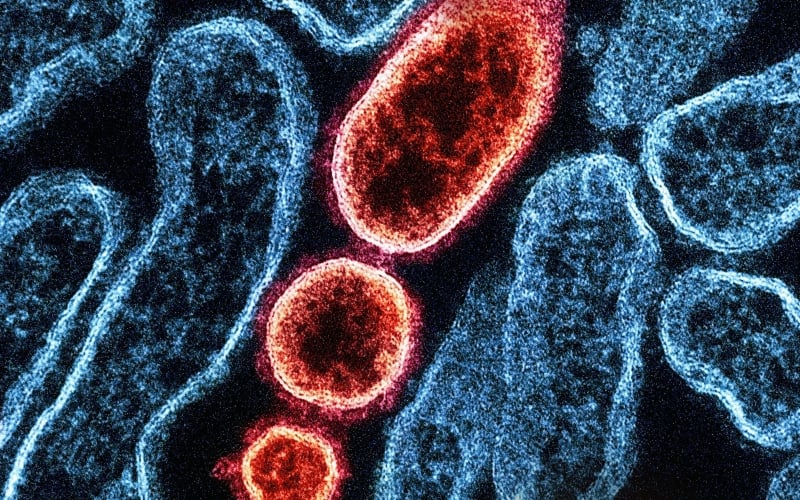 Hospitals Fighting Measles Confront a Challenge: Few Doctors Have Seen It Before