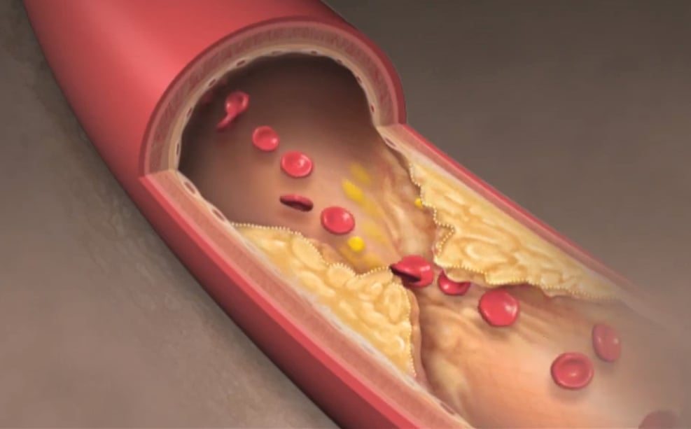 Ask for an Ultrasound Screening to Cut Vascular Dementia Risk in Half