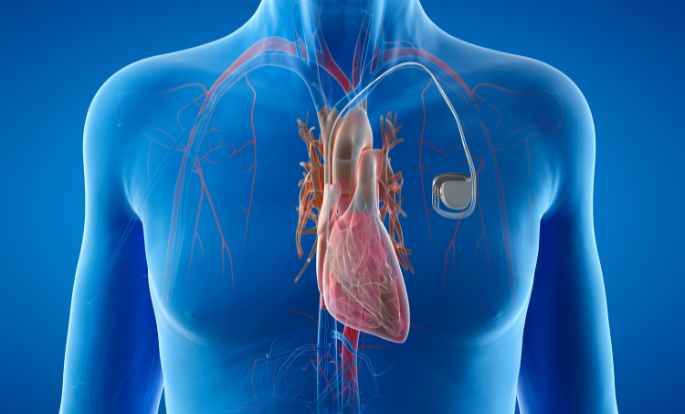 Getting to the Heart of the Matter: Living and Loving After Getting a Pacemaker