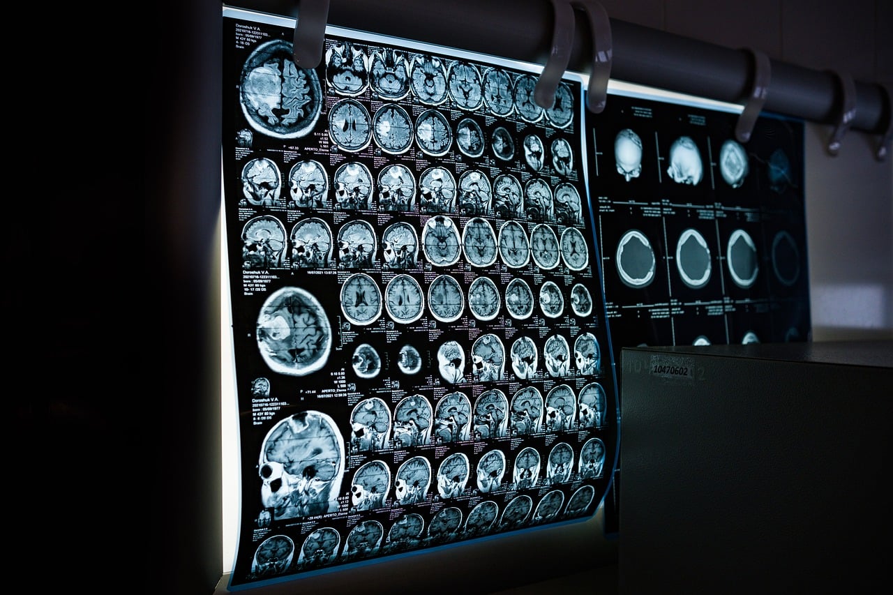 11 Myths About Alzheimer’s