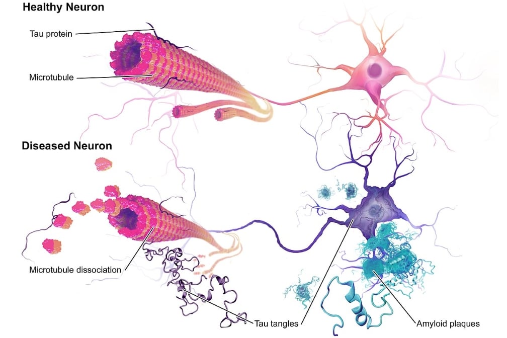 To Cure Alzheimer’s, Get Rid of Tau, Too